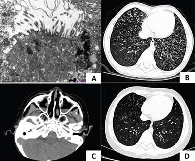 Case Report: Primary ciliary dyskinesia due to CCNO mutations: a Chinese pediatric case series and literature review